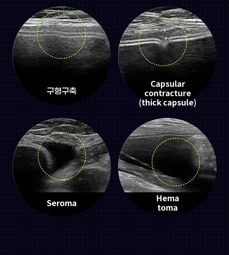 ❤View❤Motiva Breast Revision Surgery