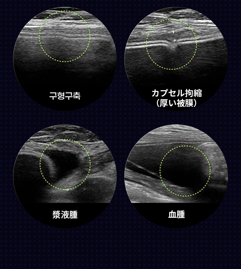 ❤ビュー❤モティバ 胸再手術