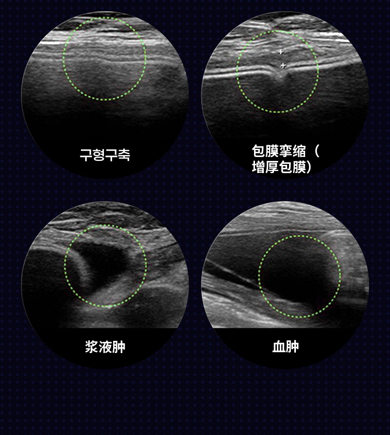 ❤视图❤Motiva胸部再手术