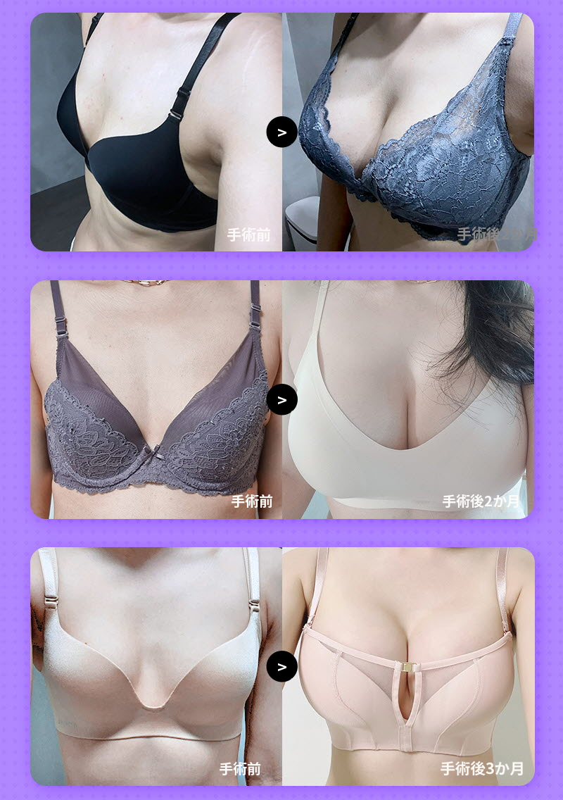 ❤ビュー❤モティバ 胸再手術