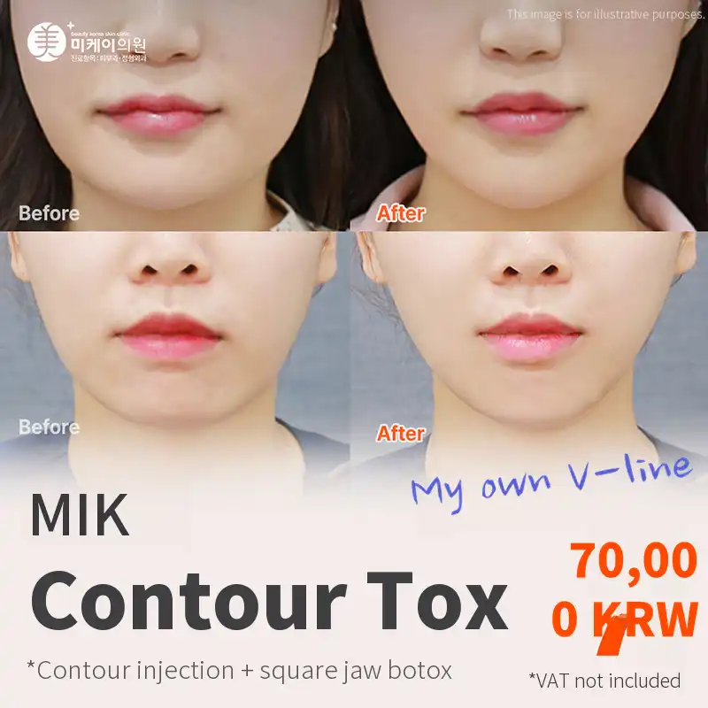 Mickey V-Line Contouring Injection + Square Jaw Botox