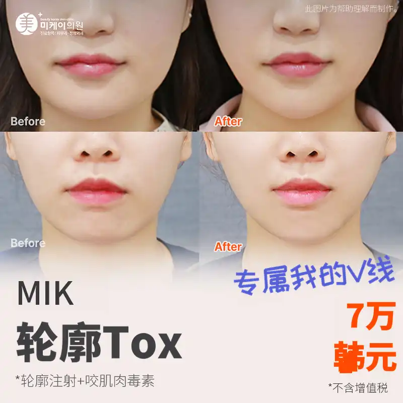 美凯 V线轮廓针+方下巴肉毒杆菌