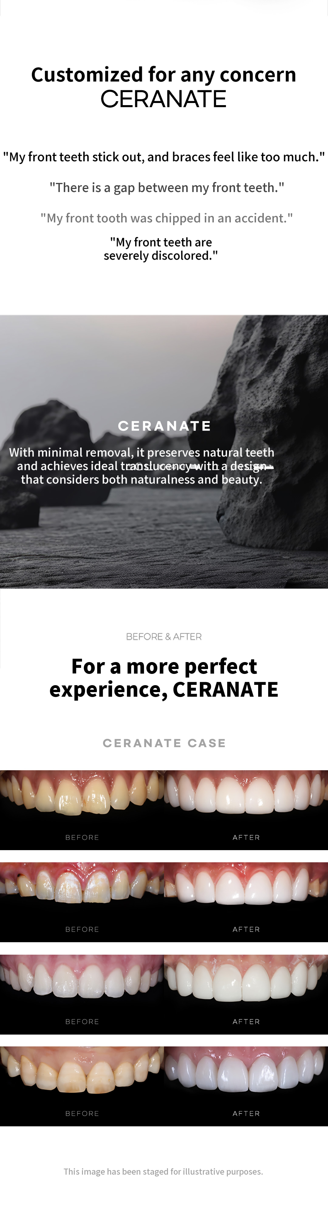 ★Customized Cerinate Veneers with No Additional Cost★