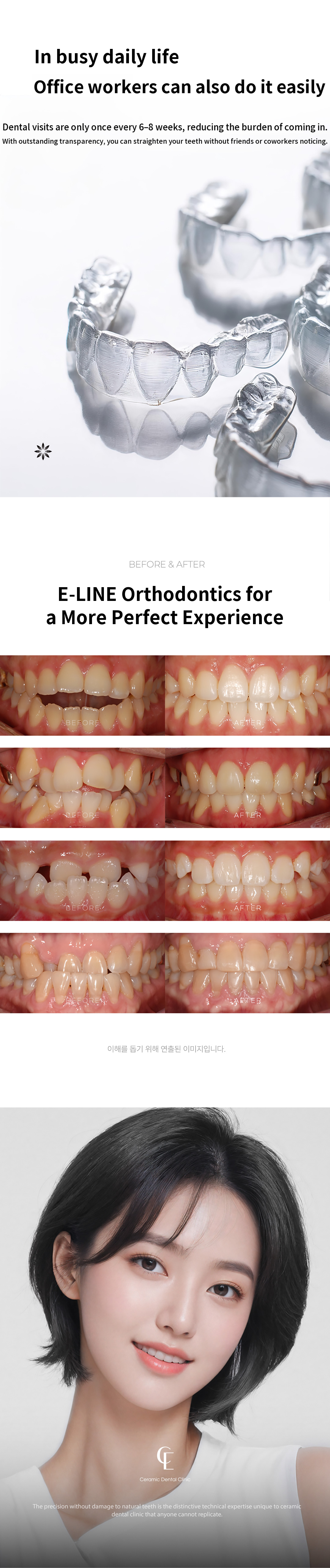 ★Personal Teeth Alignment from 150,000 KRW per month~★