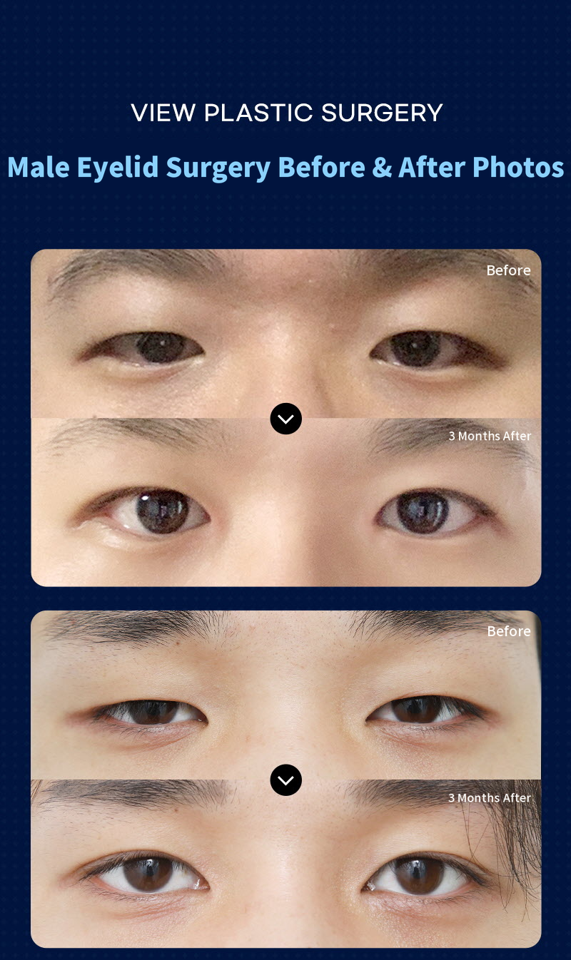 ❤️View❤️ Men's Eye Surgery