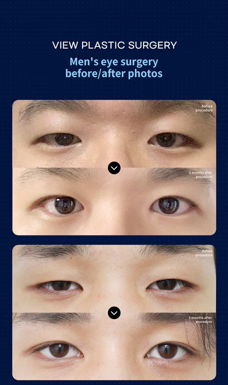 ❤️View❤️Male Eye Surgery