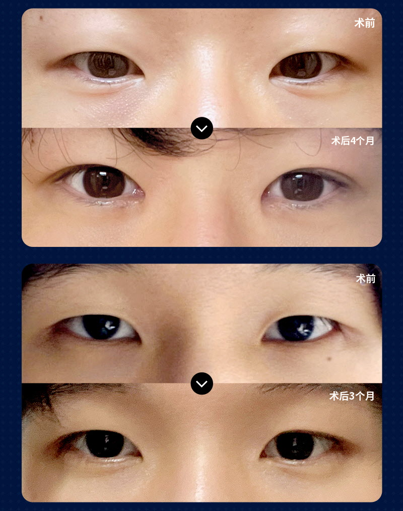 ❤️视线❤️男士眼部整形
