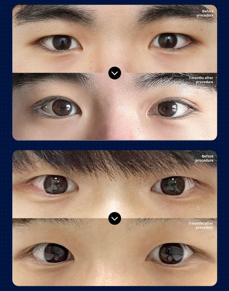 ❤️View❤️Male Eye Surgery