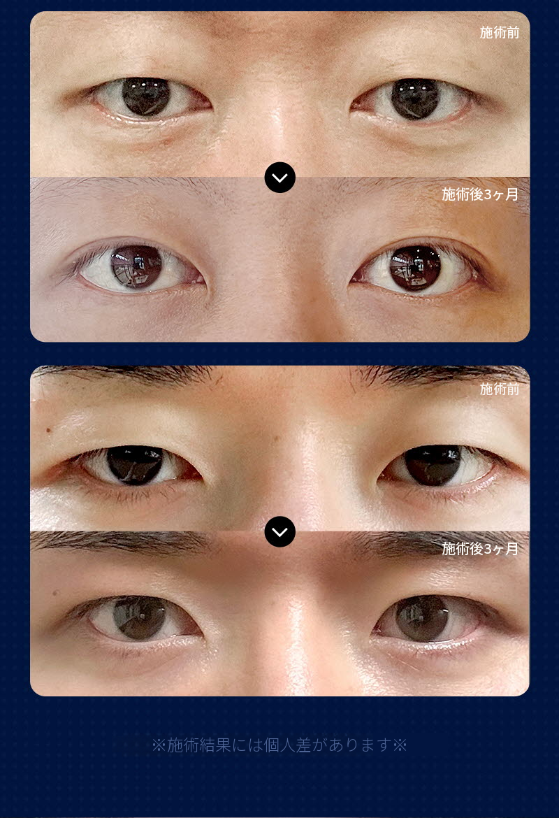 ❤️ビュ❤️男性の目の整形
