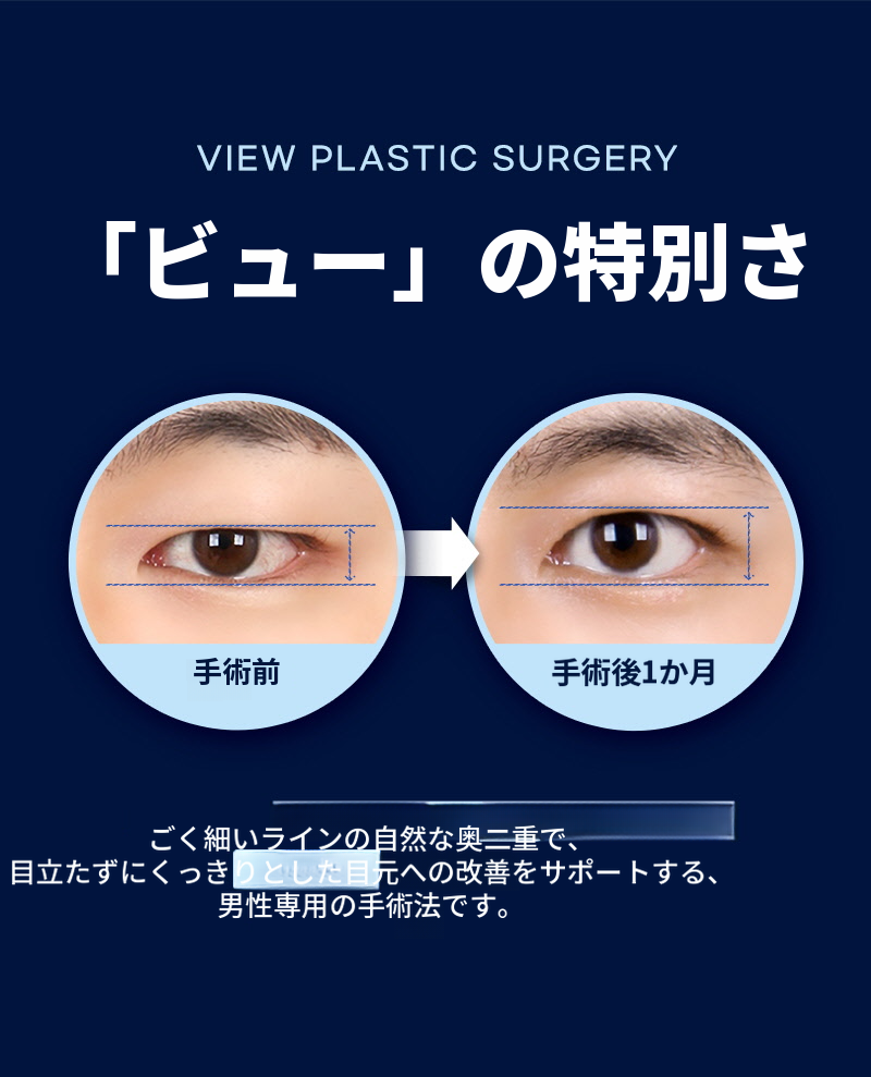 ❤️ビュー❤️男性の目の整形