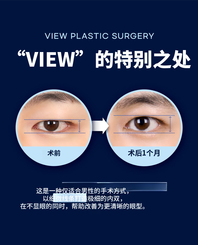 ❤️视线❤️男士眼部整形