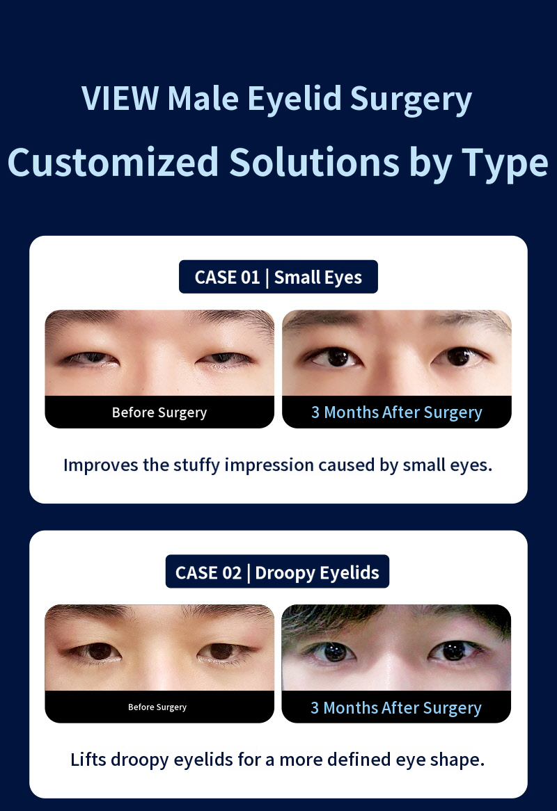❤️View❤️ Men's Eye Surgery