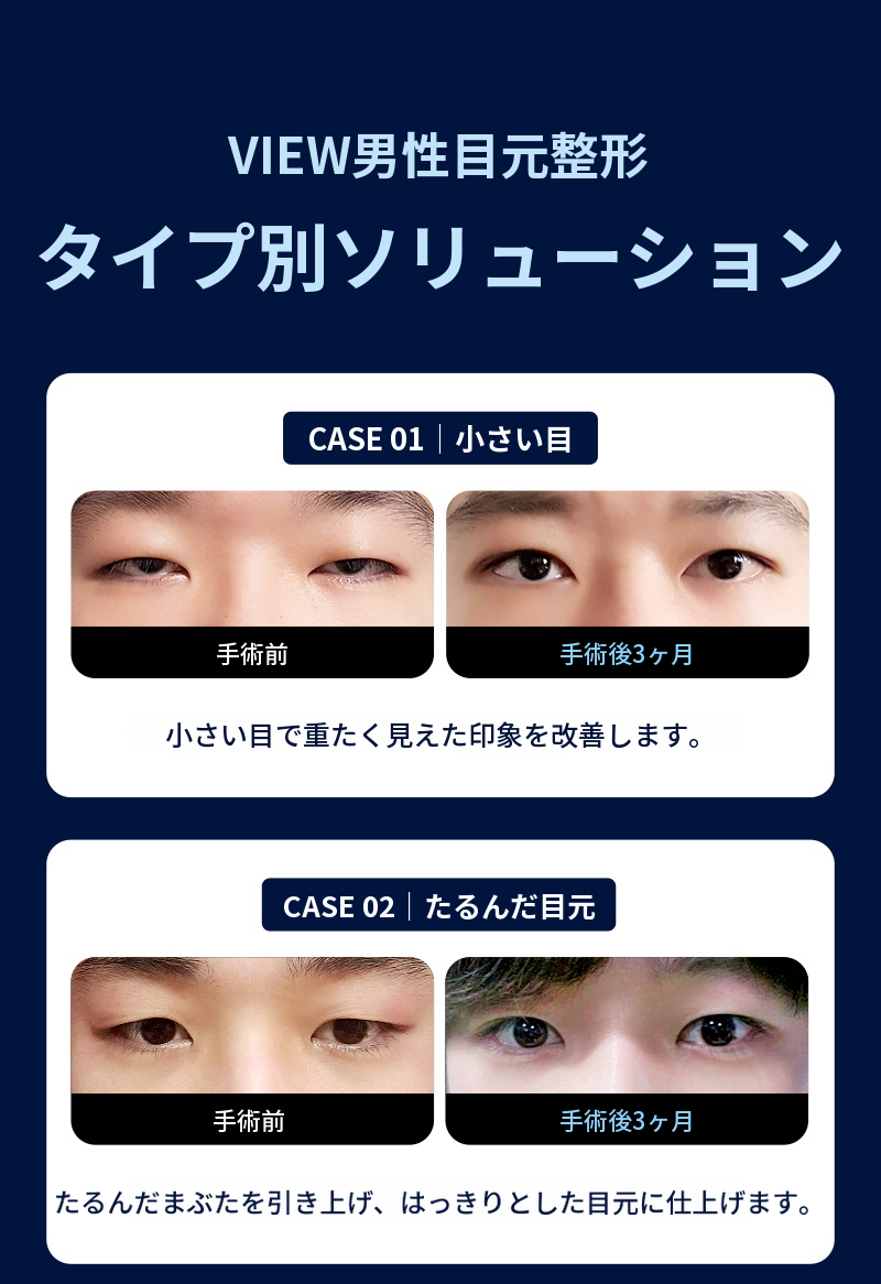 ❤️ビュ❤️男性の目の整形