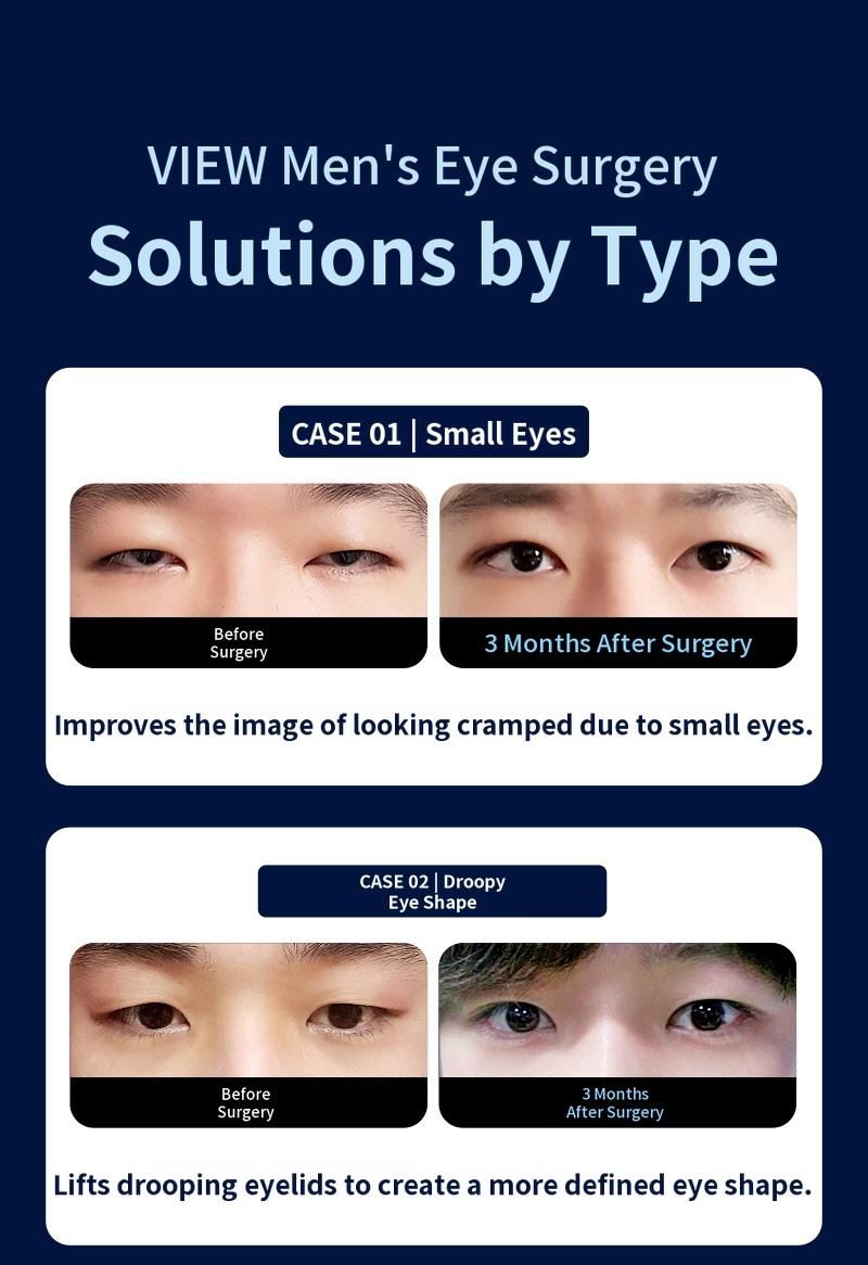 ❤️View❤️Male Eye Surgery