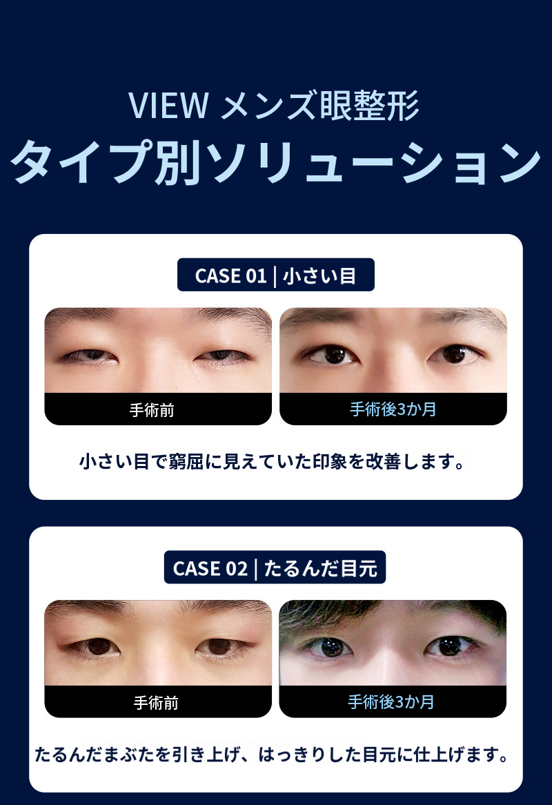 ❤️ビュー❤️男性の目の整形