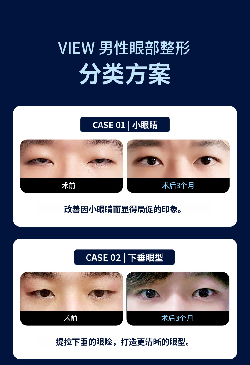 ❤️视线❤️男士眼部整形