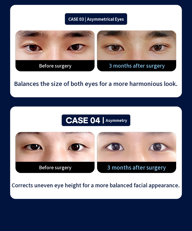 ❤️View❤️ Men's Eye Surgery