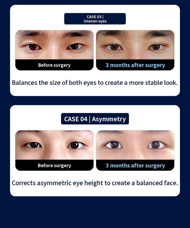 ❤️View❤️Male Eye Surgery