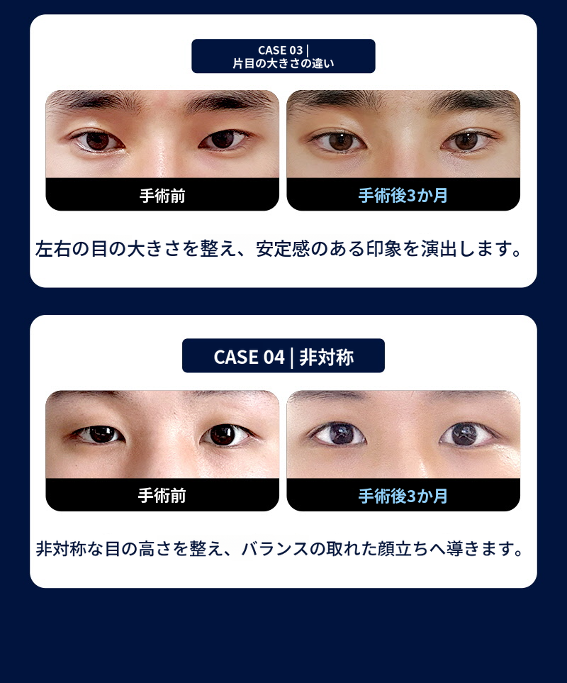 ❤️ビュー❤️男性の目の整形