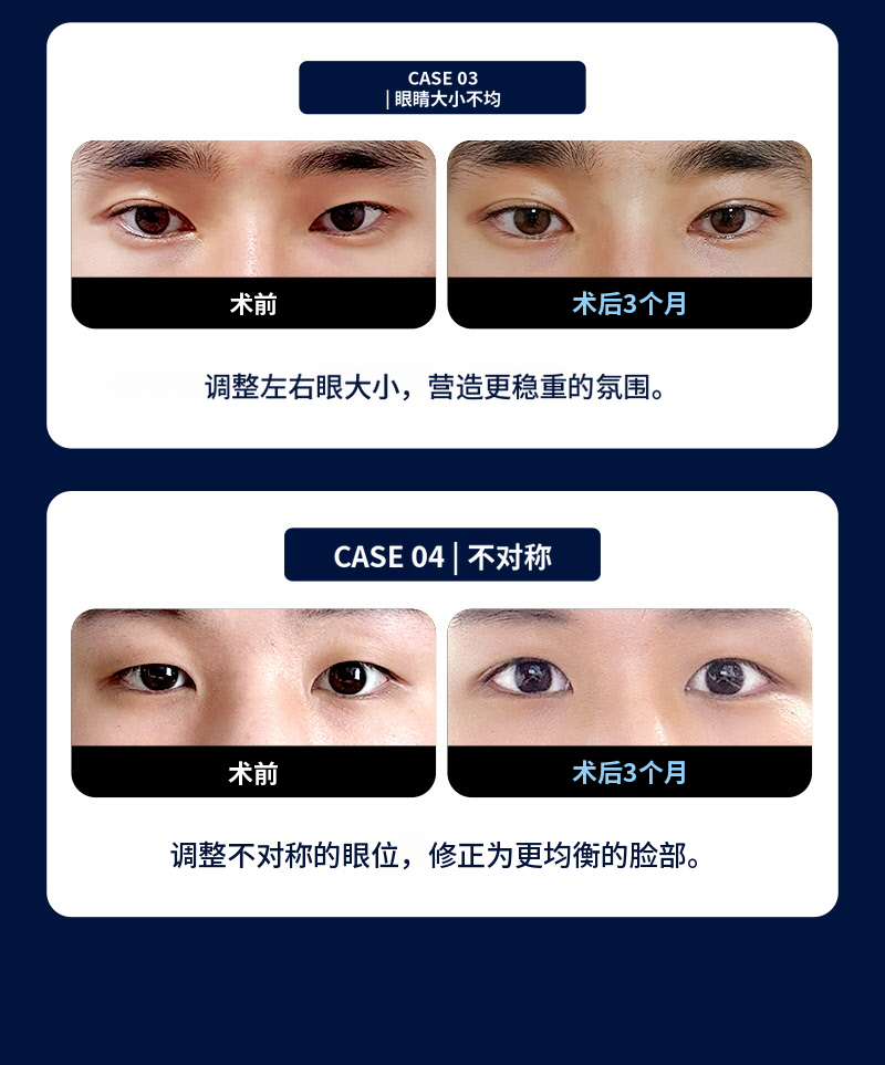 ❤️视线❤️男士眼部整形