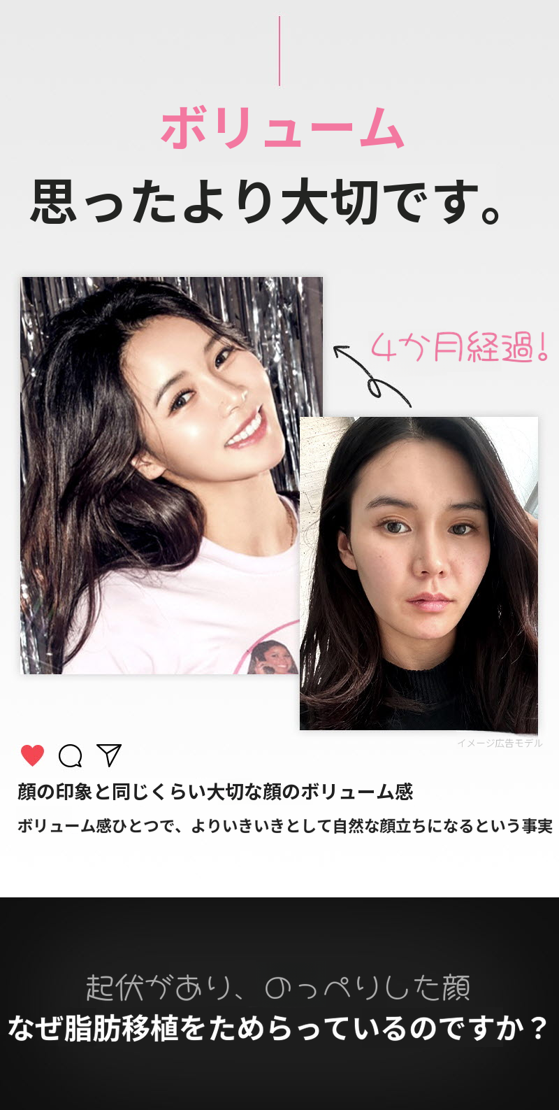 ❤️ビュー❤️顔の脂肪移植