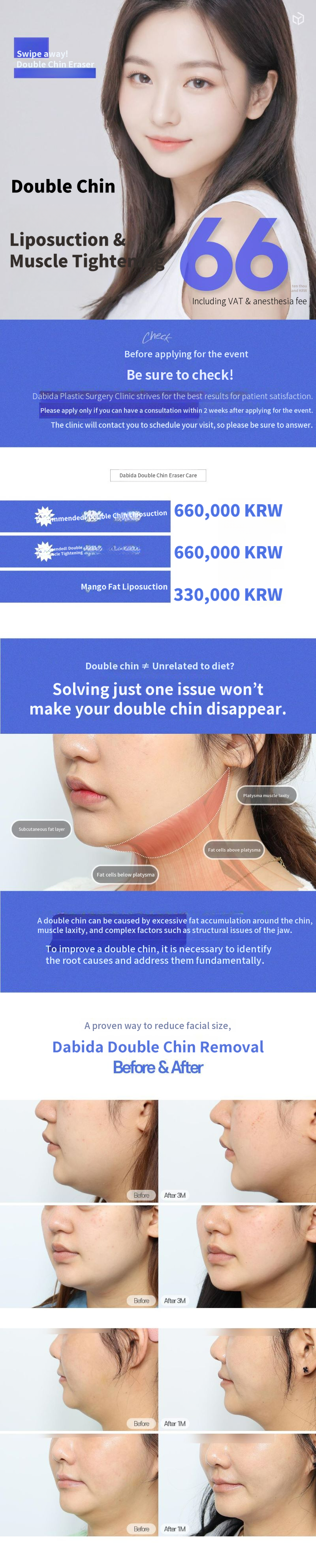 Davida Double Chin Eraser Liposuction & Muscle Stitching