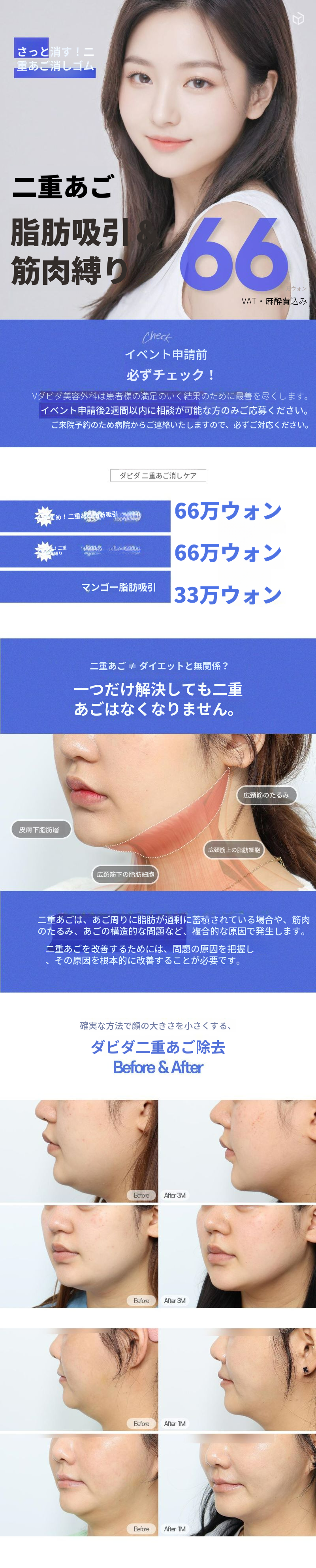 ダビダ二重あご消し脂肪吸引＆筋肉結束