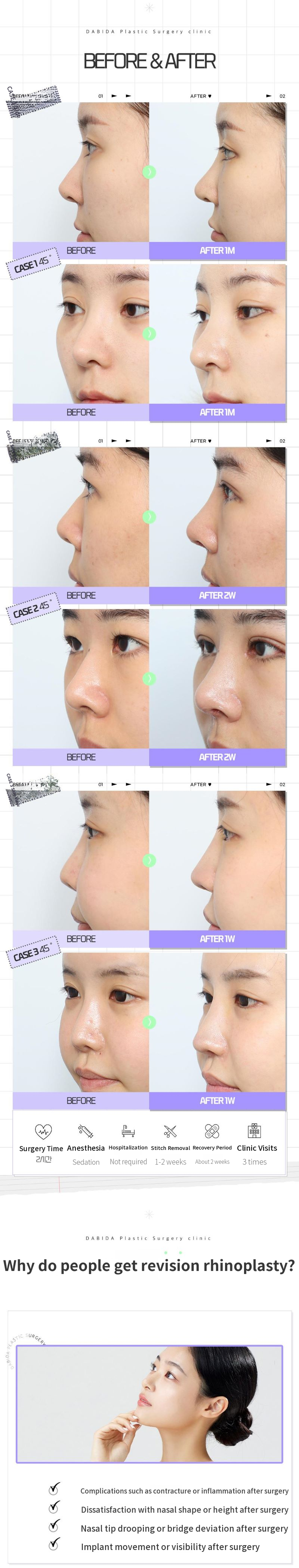 Davida Final Nose Revision Surgery