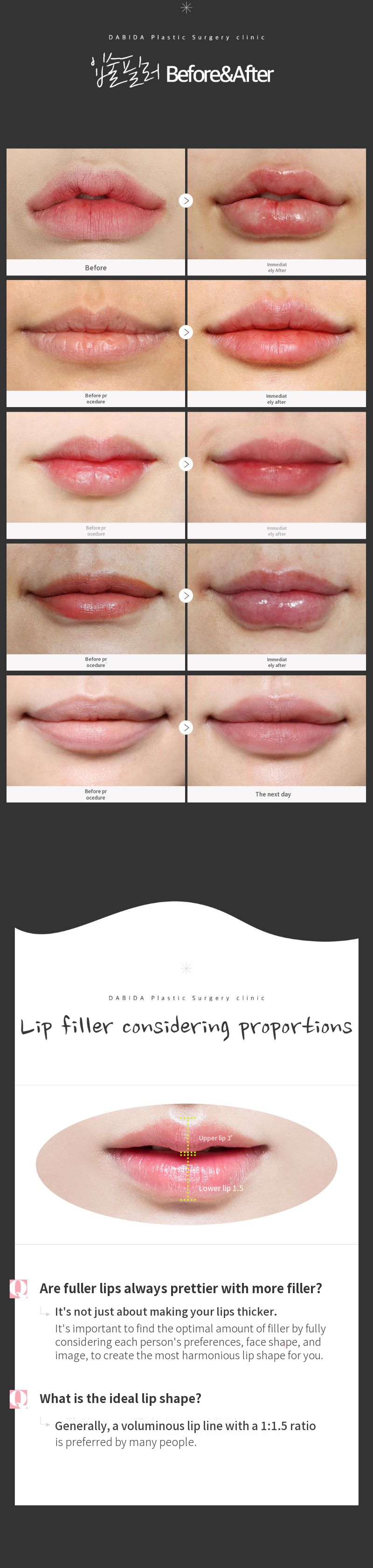 Golden Ratio 115 Lip Filler
