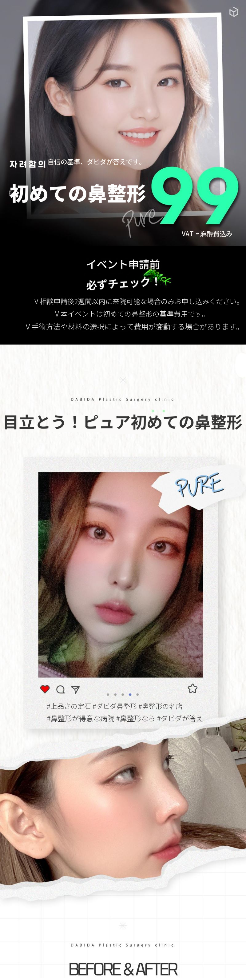 ダビダピュア初鼻整形