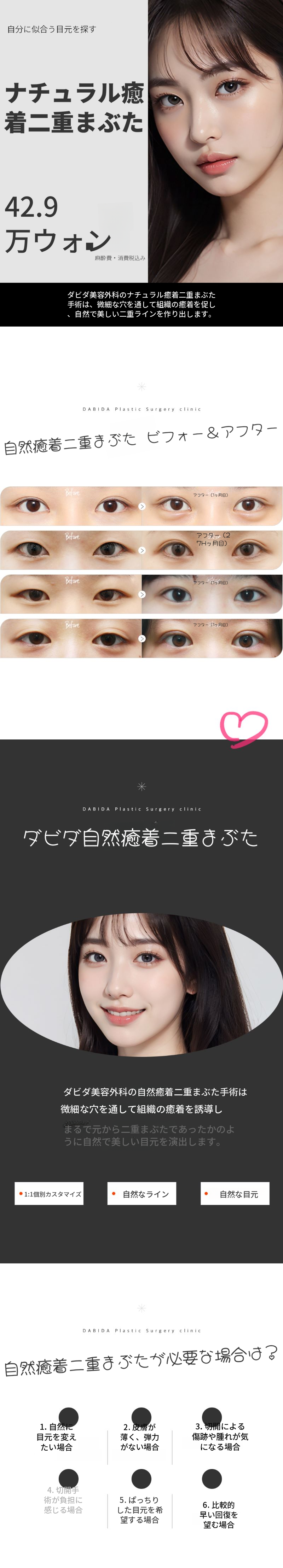 ダビダ自然癒着二重まぶた