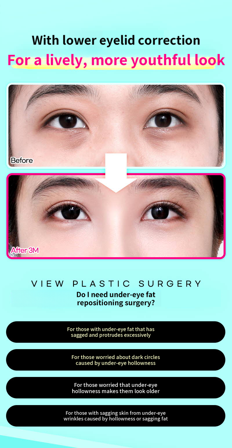 ❤️View❤️Lower Eyelid Fat Repositioning