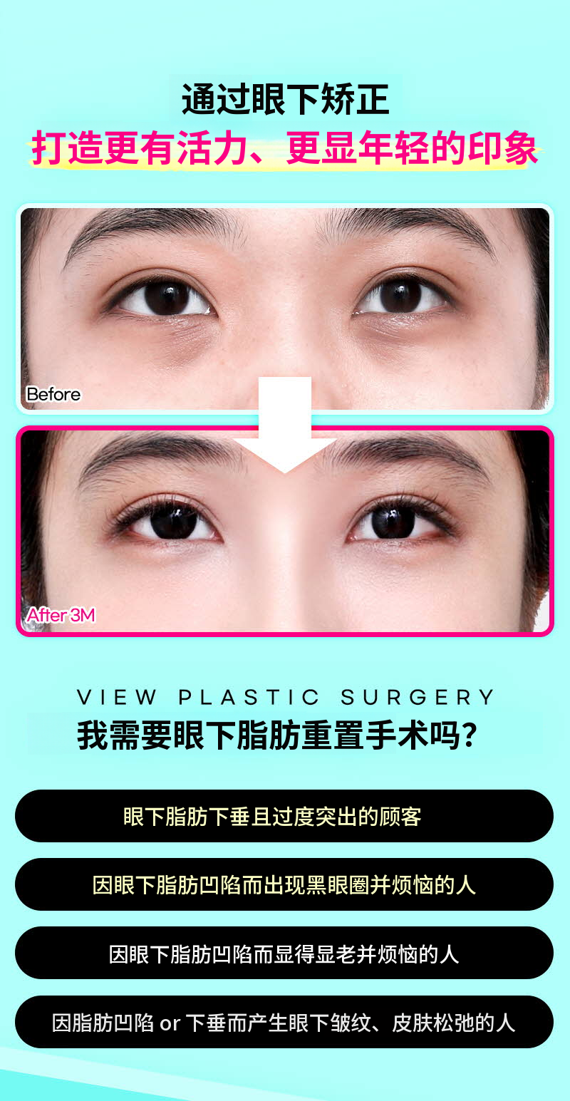 ❤️视线❤️下眼睑脂肪重塑