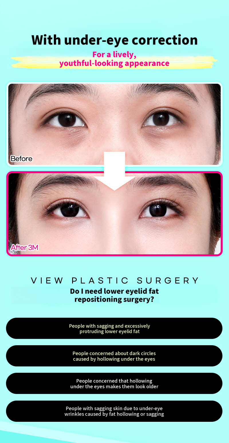 ❤️View❤️Under-Eye Fat Repositioning