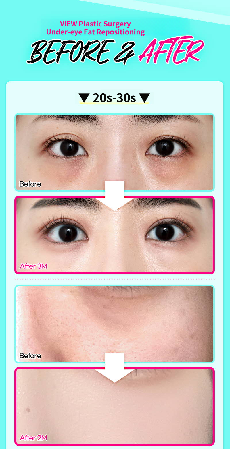 ❤️View❤️Lower Eyelid Fat Repositioning