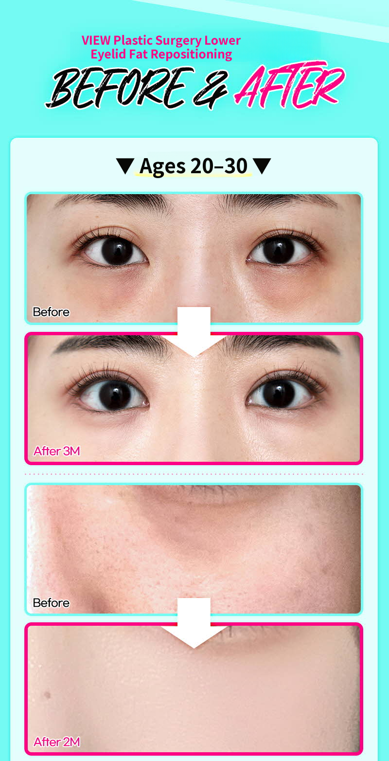 ❤️View❤️Under-Eye Fat Repositioning