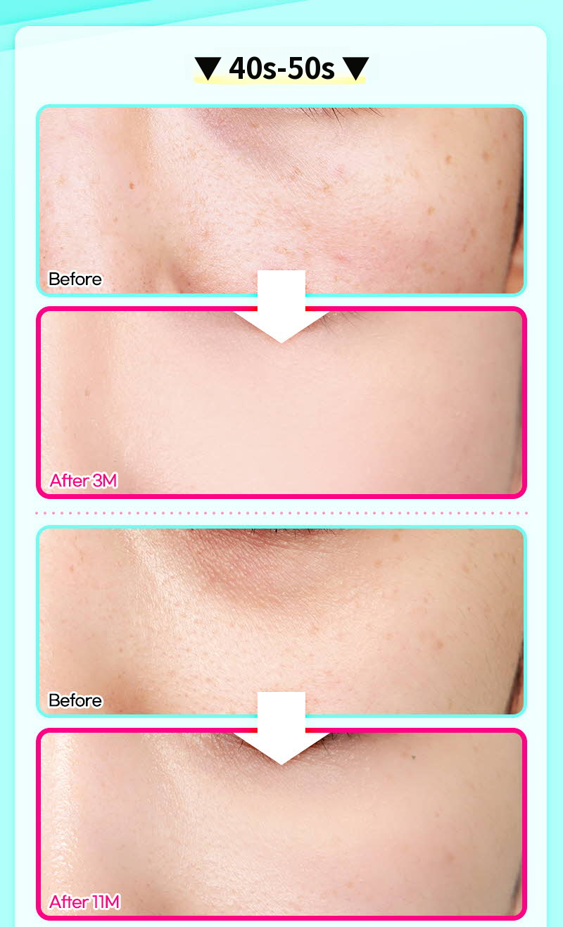 ❤️View❤️Lower Eyelid Fat Repositioning