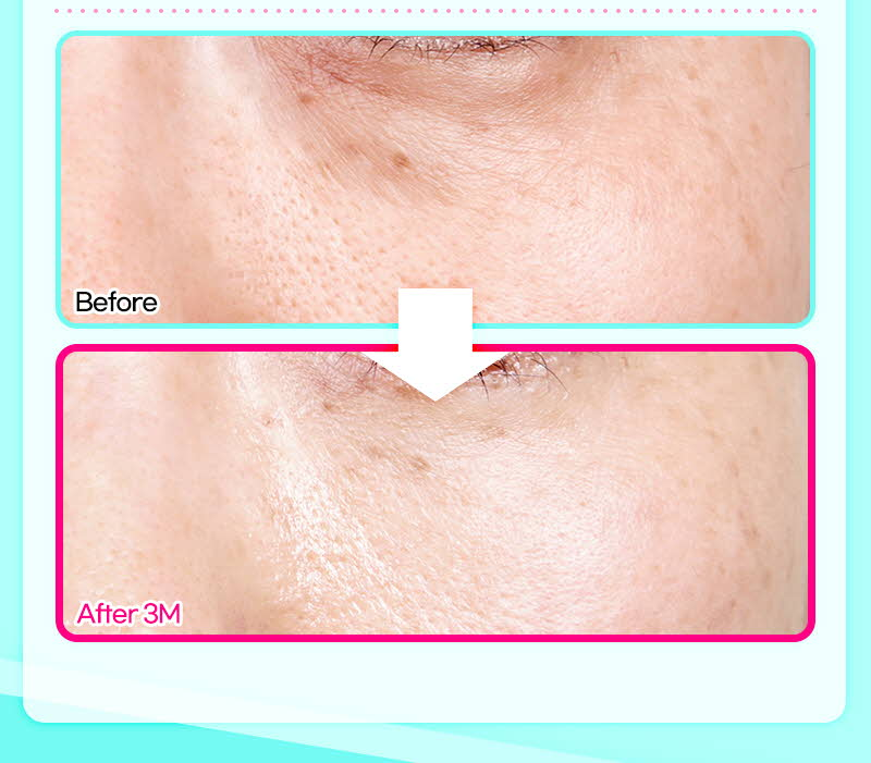 ❤️ビュー❤️目の下脂肪再配置