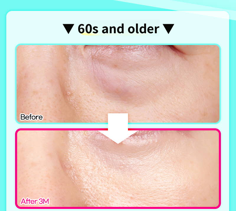 ❤️View❤️Lower Eyelid Fat Repositioning