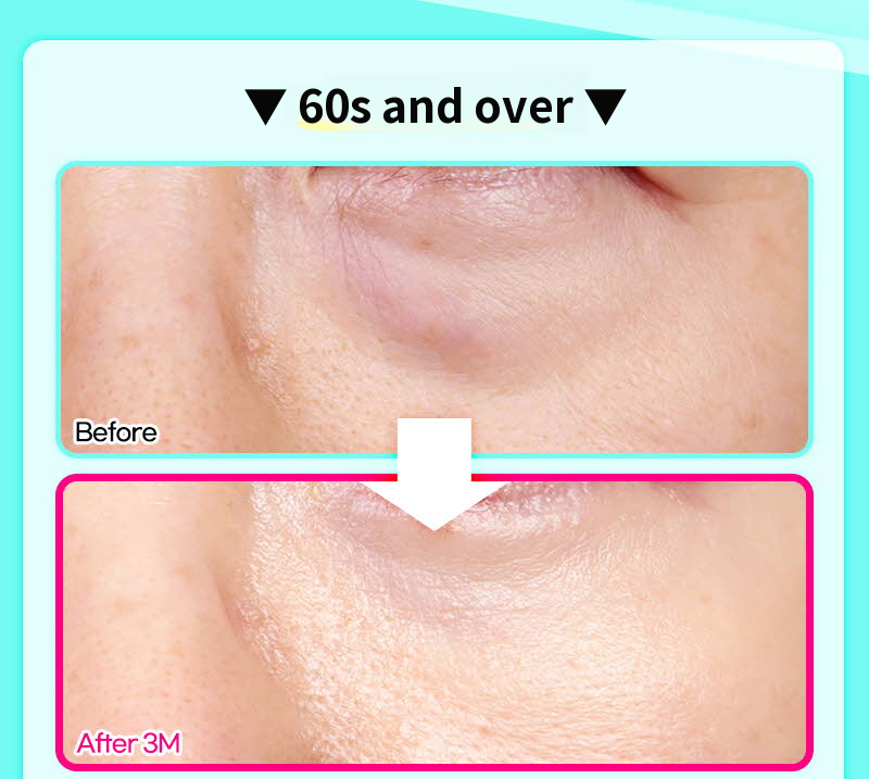 ❤️View❤️Under-Eye Fat Repositioning