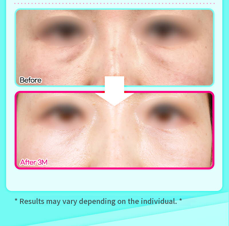 ❤️View❤️Lower Eyelid Fat Repositioning