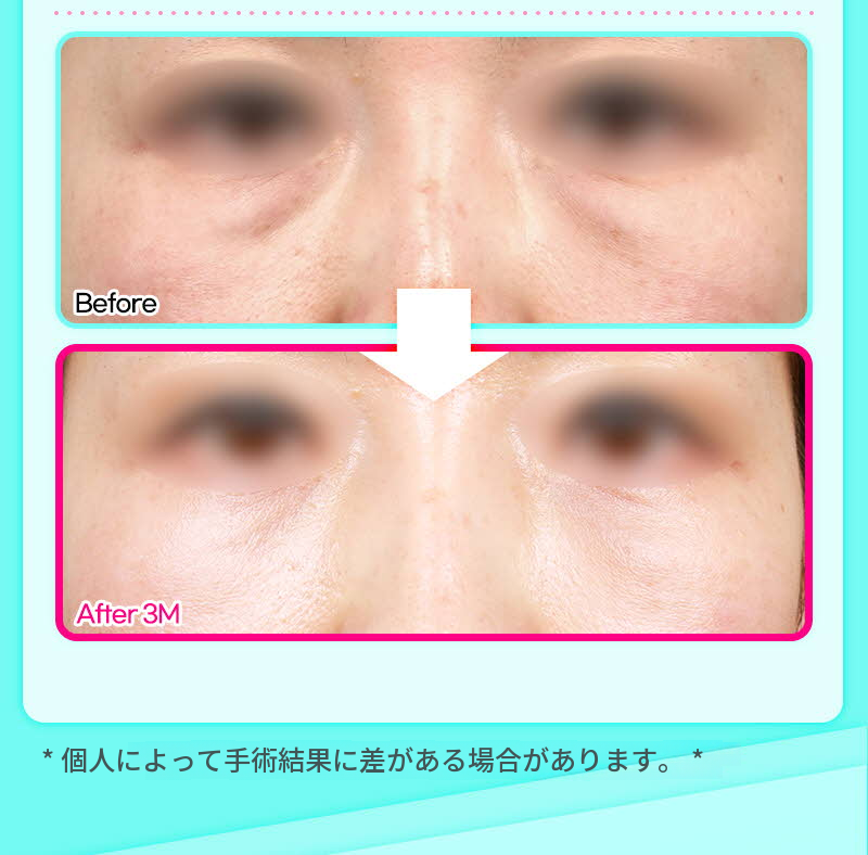 ❤️ビュー❤️目の下脂肪再配置