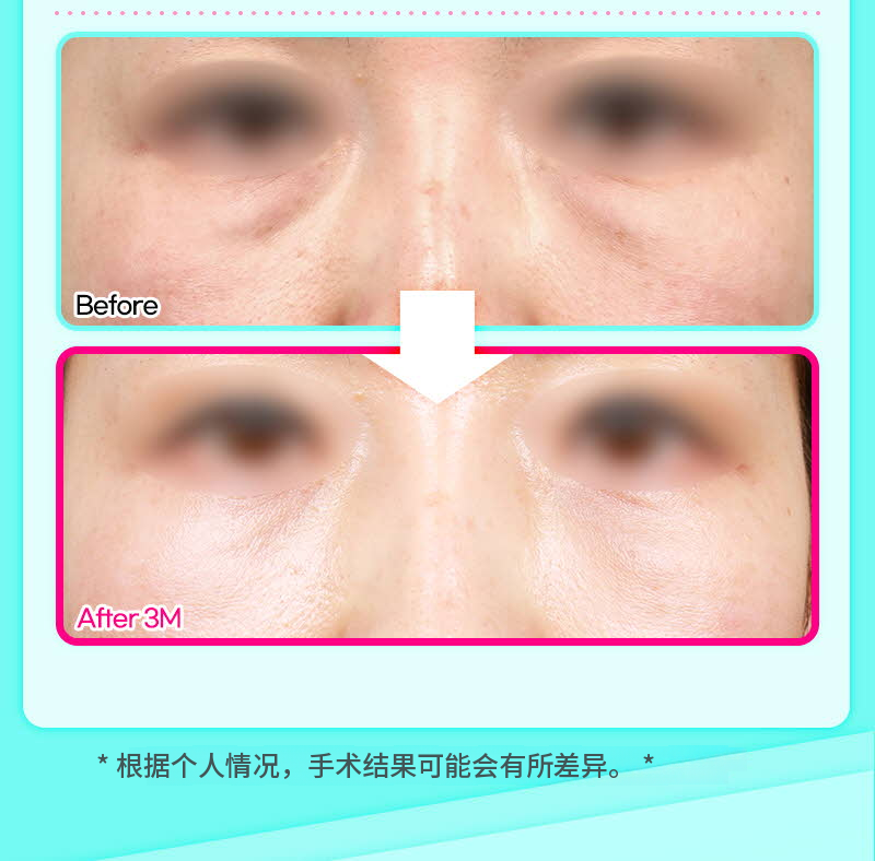 ❤️视线❤️下眼睑脂肪重塑