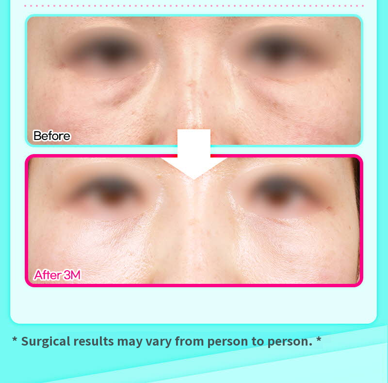 ❤️View❤️Under-Eye Fat Repositioning