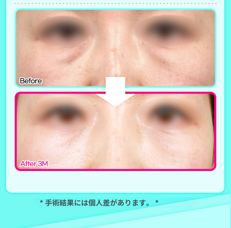 ❤️ビュー❤️目の下の脂肪再配置