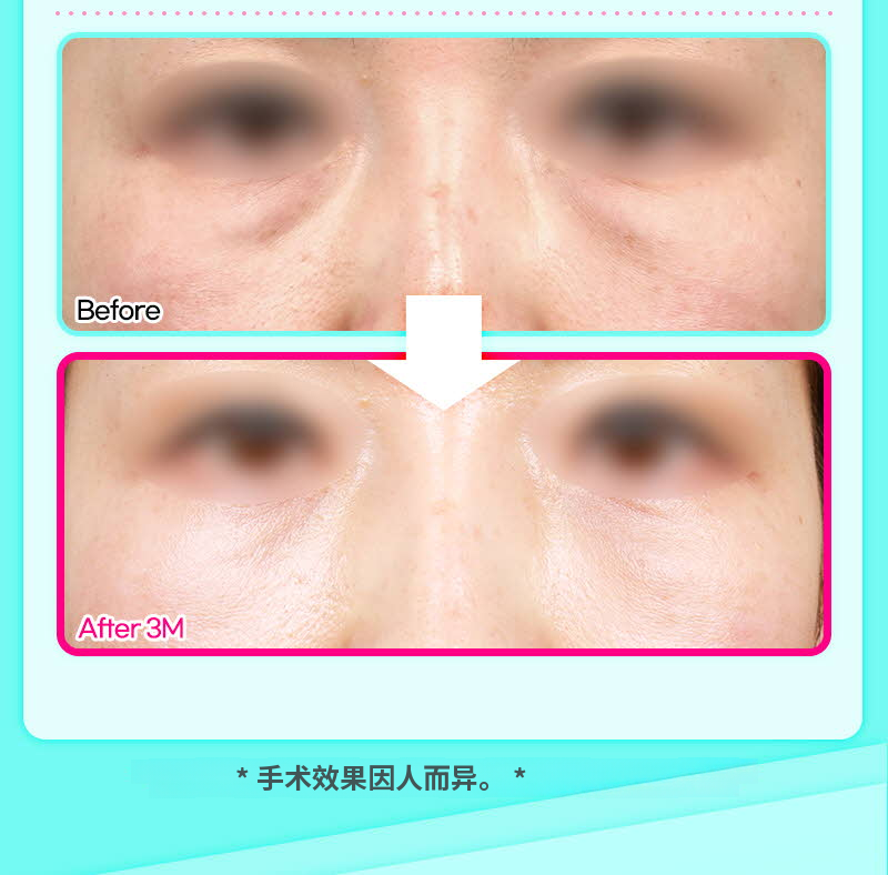 ❤️维❤️眶隔脂肪释放