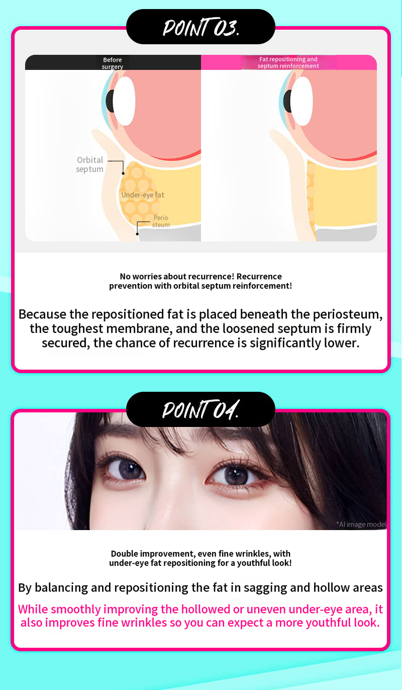 ❤️View❤️Lower Eyelid Fat Repositioning