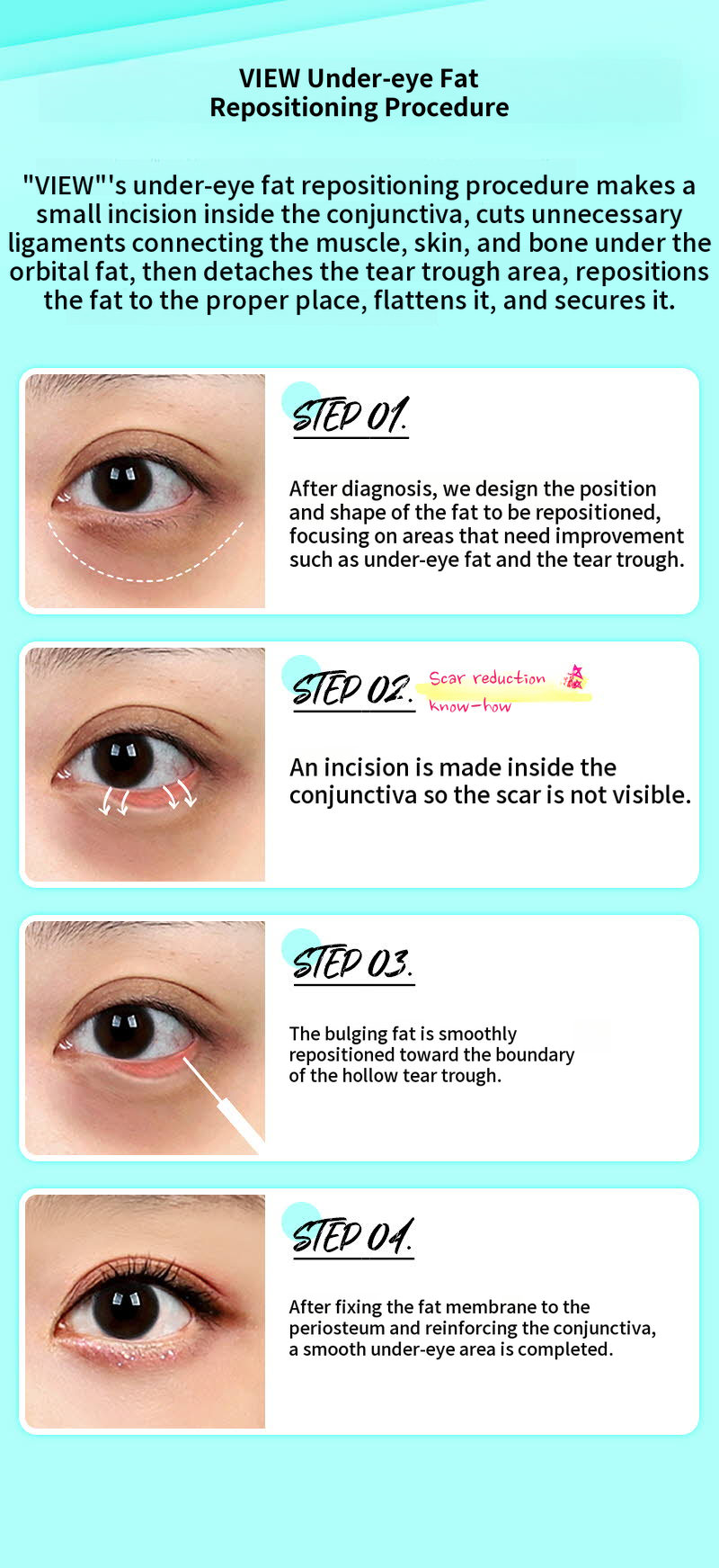 ❤️View❤️Lower Eyelid Fat Repositioning