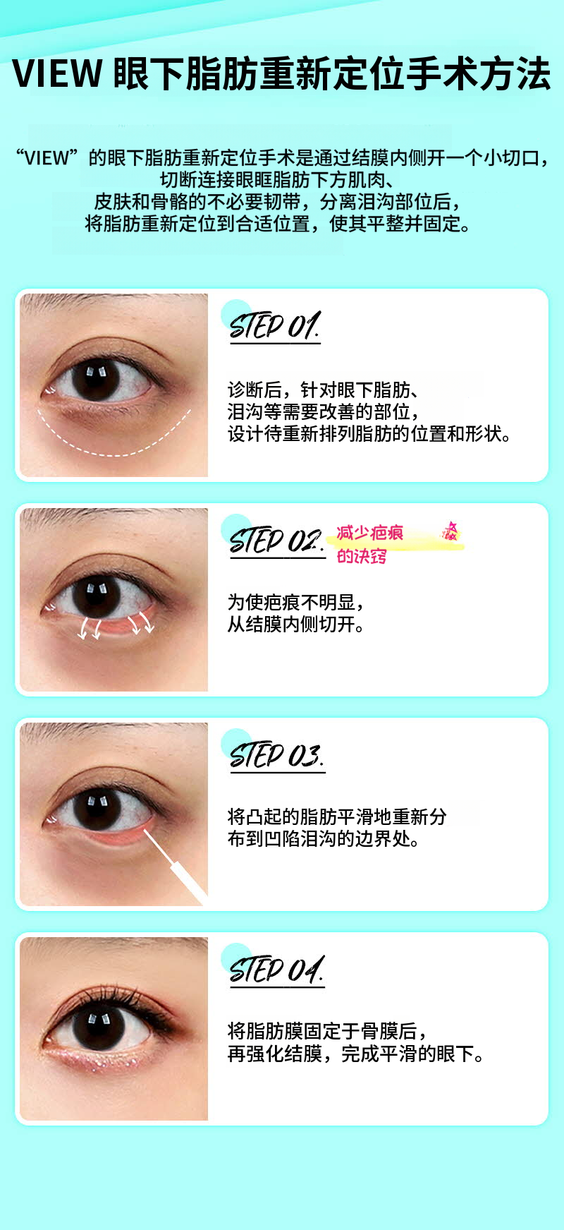 ❤️视线❤️下眼睑脂肪重塑