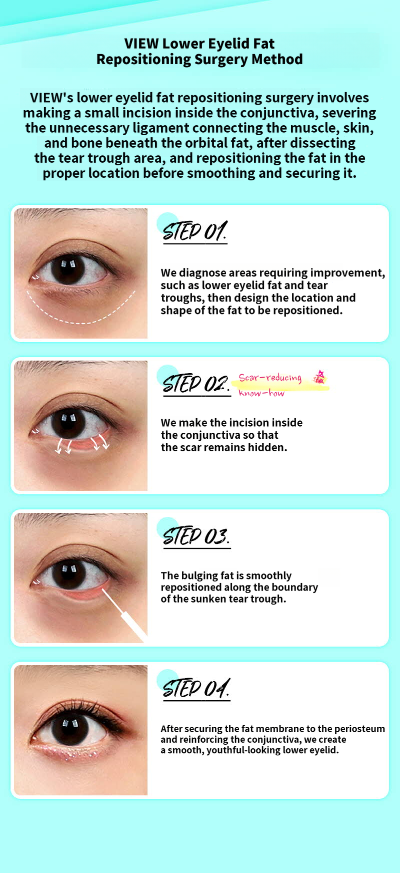 ❤️View❤️Under-Eye Fat Repositioning